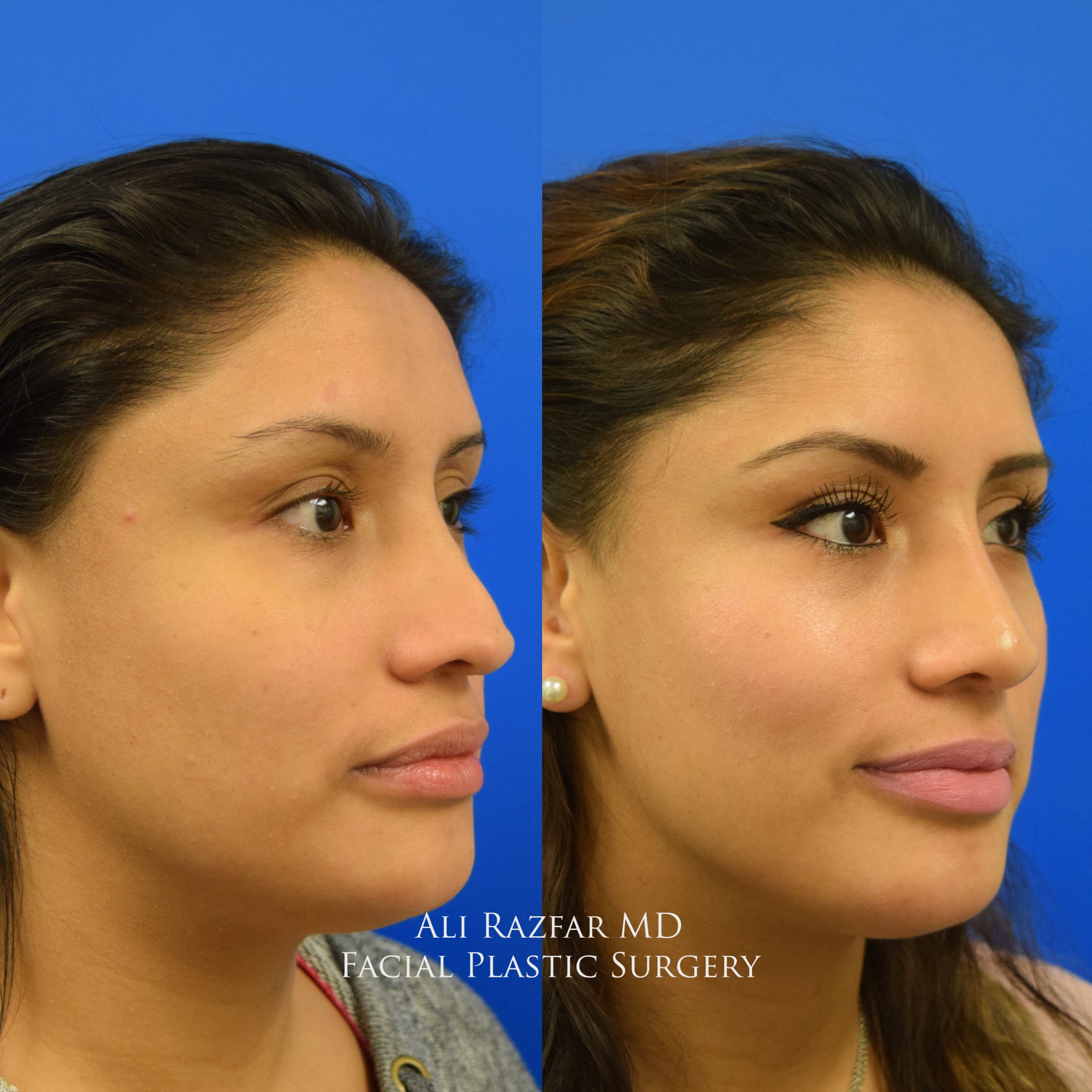 Revision Rhinoplasty Newport Beach Top Nose Job Orange County 1359